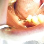 Impianti dentali