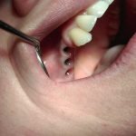 Fase 1. Gli impianti dentali – margine gengivale
