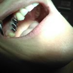 Fase 3. I monconi di transfer sugli impianti dentali