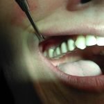 Fase 4. Il manufatto fisso sugli impianti dentali